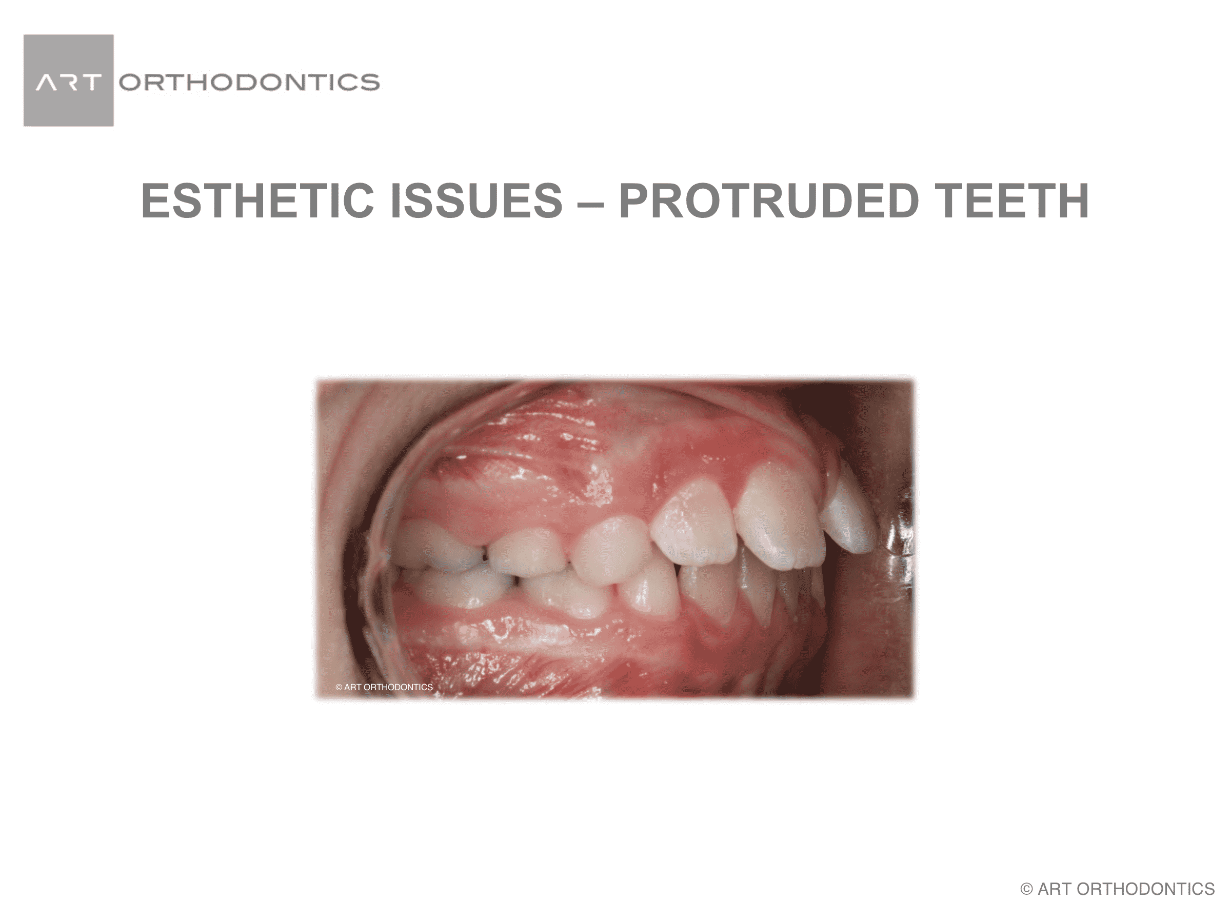 Protruded upper front teeth