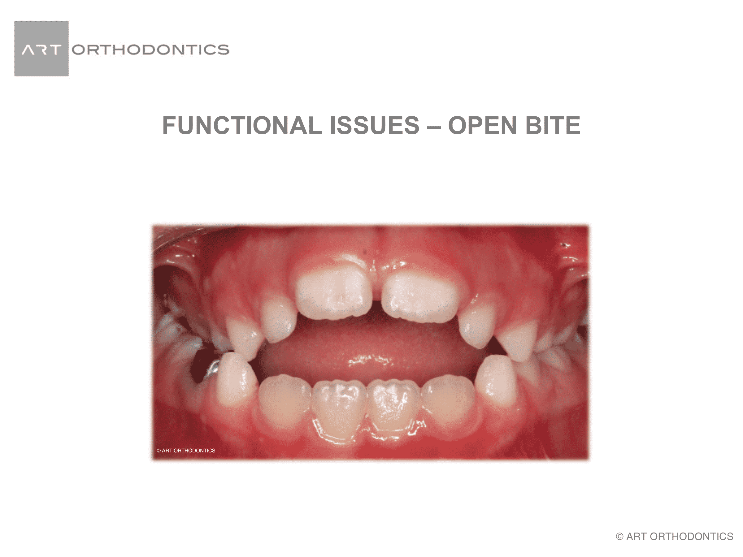 Mordida abierta anterior y lengua grande