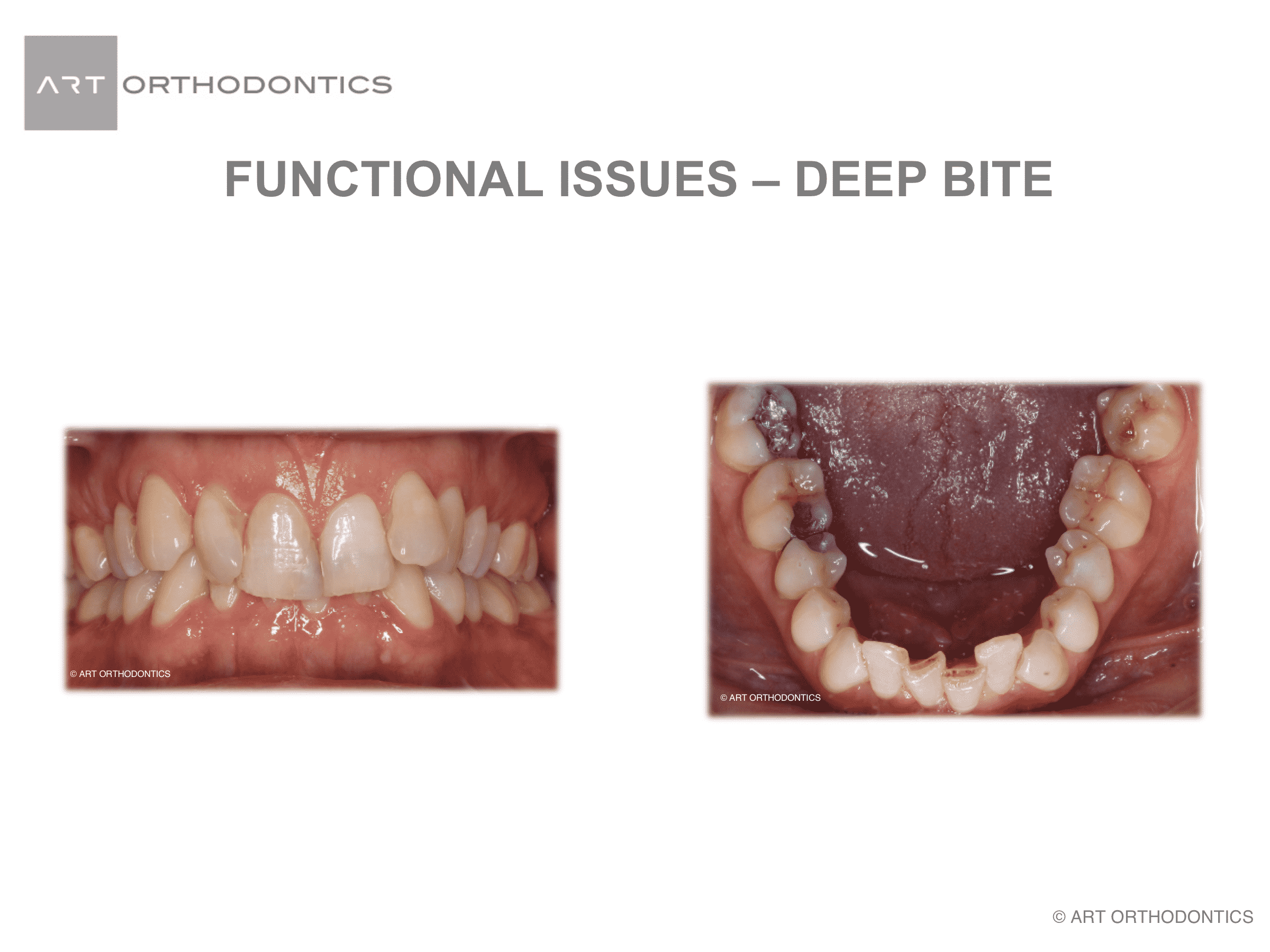 Beep bite teeth taken from the front and of the lower arch