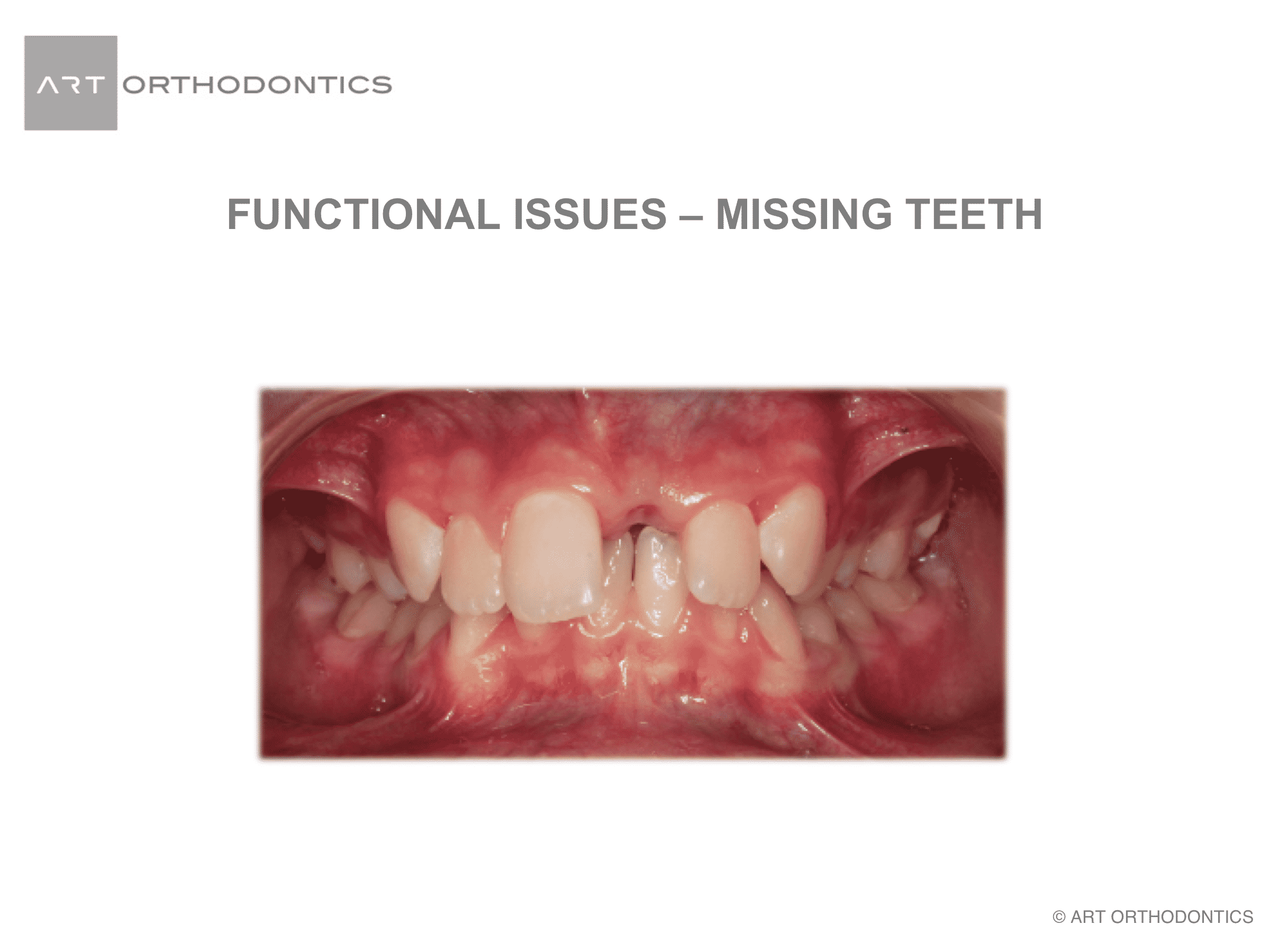 Missing upper left central incisor after trauma before orthodontic treatment