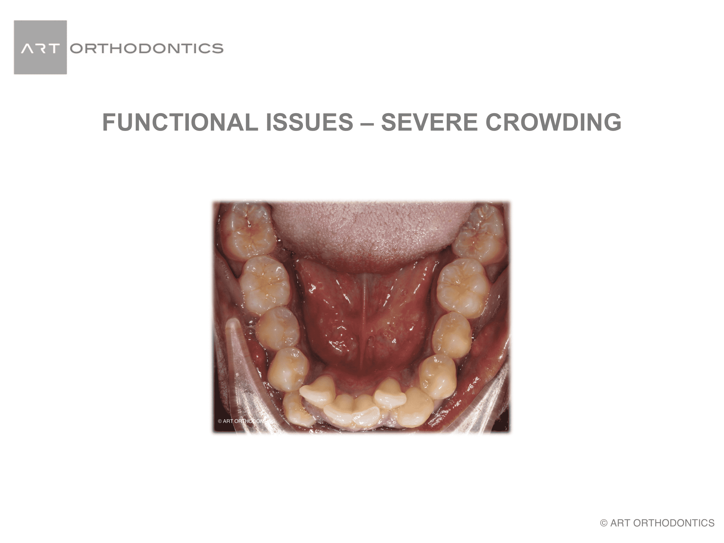 Lower jaw with severe crowding