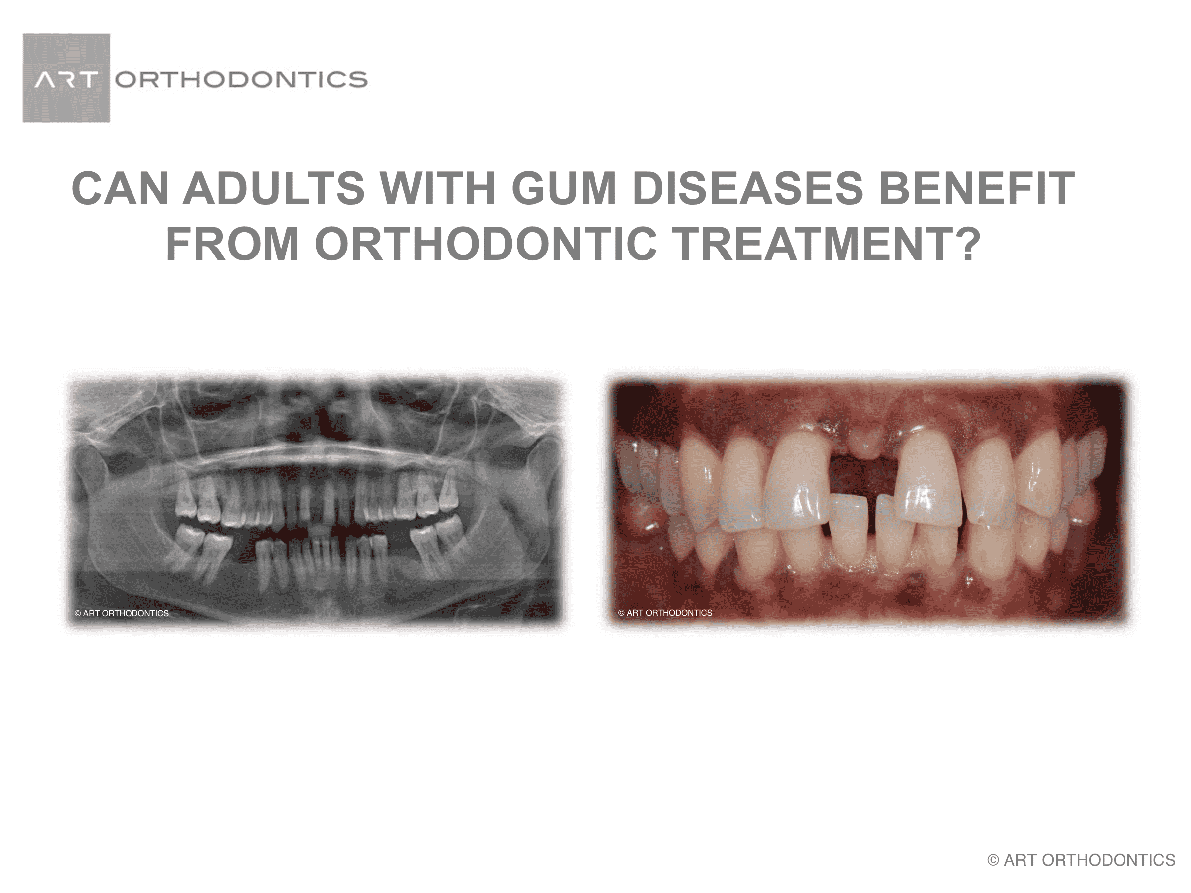 Panoramic xray and teeth with large gap between the upper front teeth