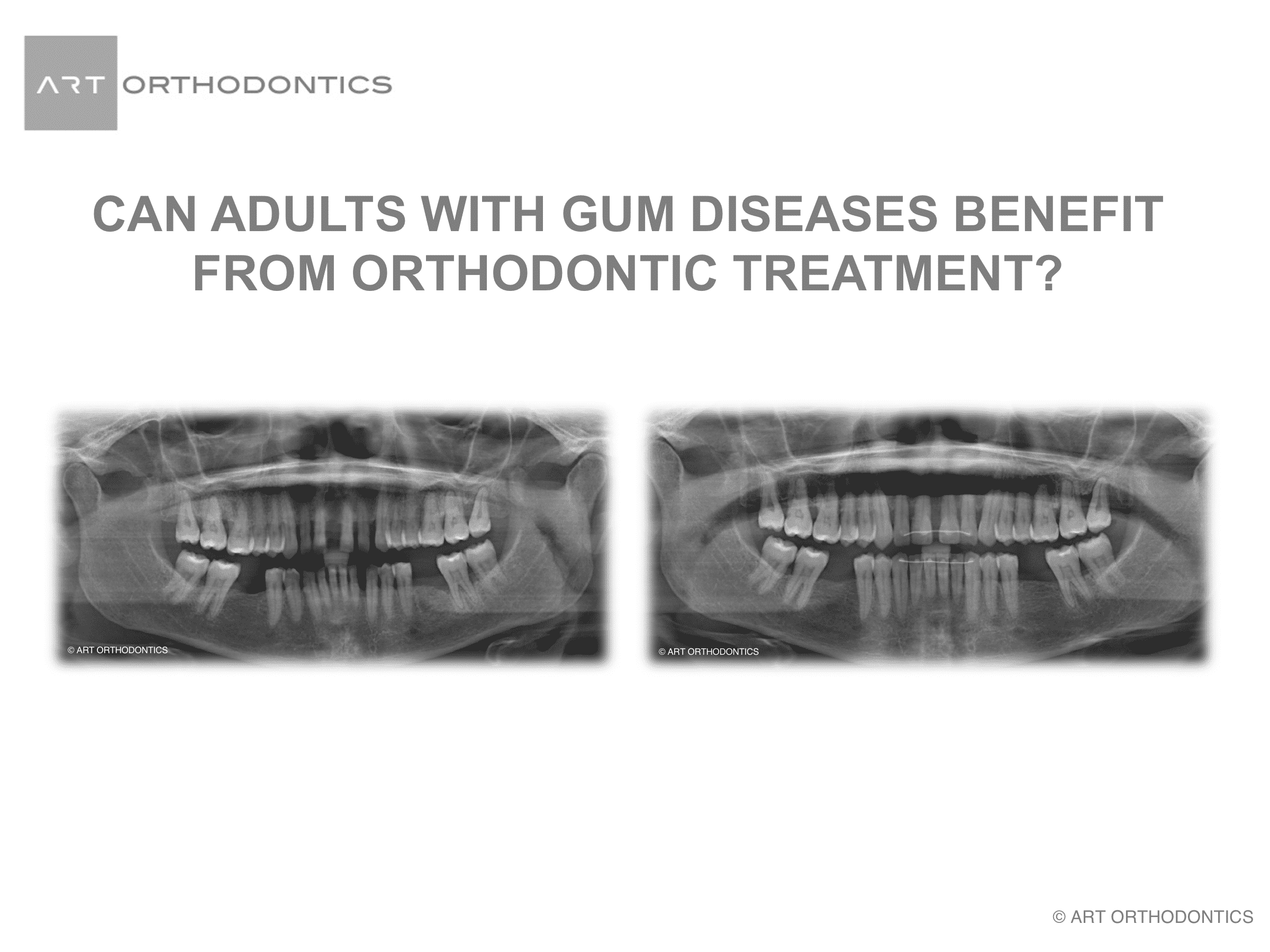 Panoramic x-rays of dentition with missing lower teeth