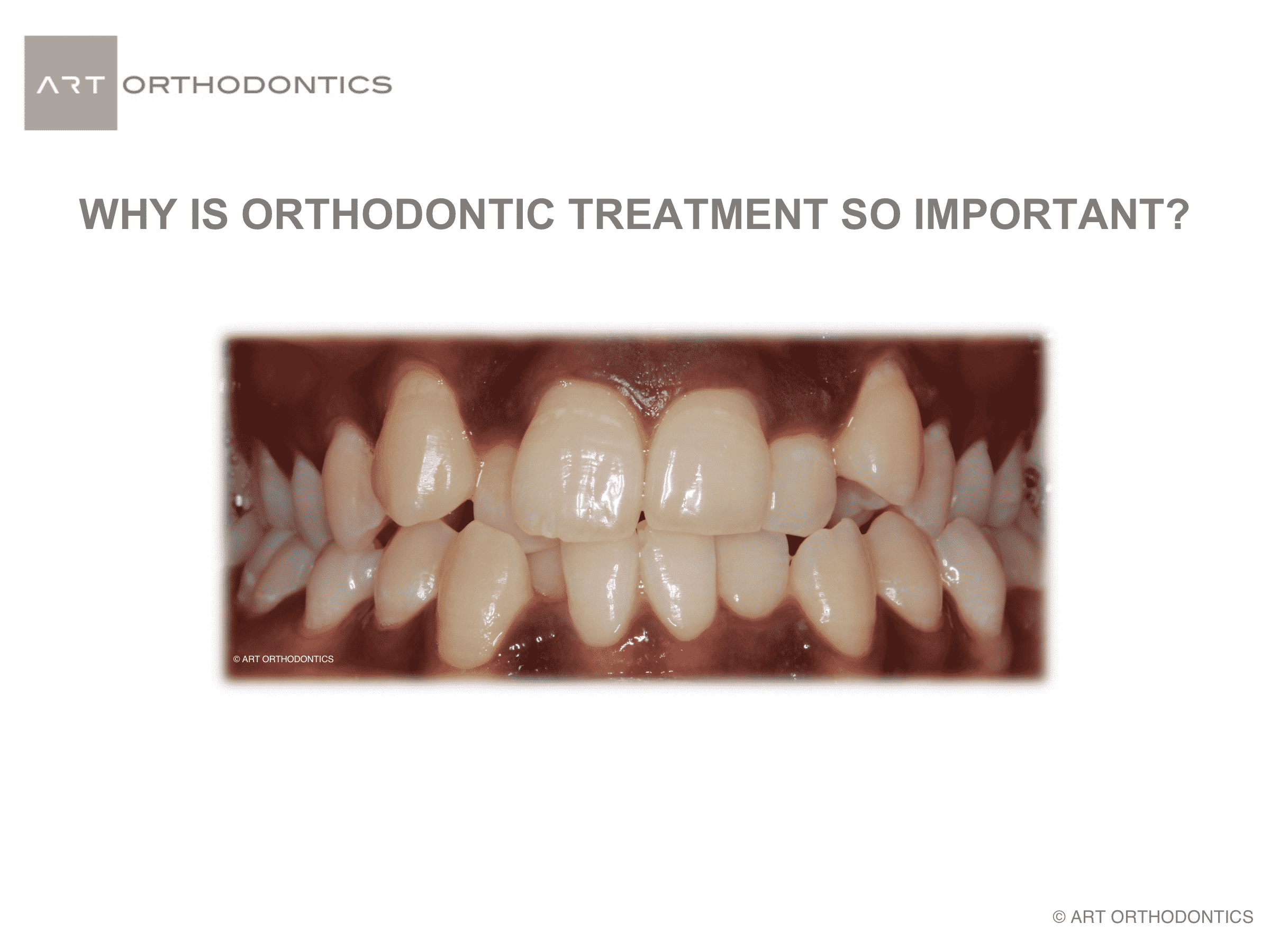 Anterior picture of crowded teeth