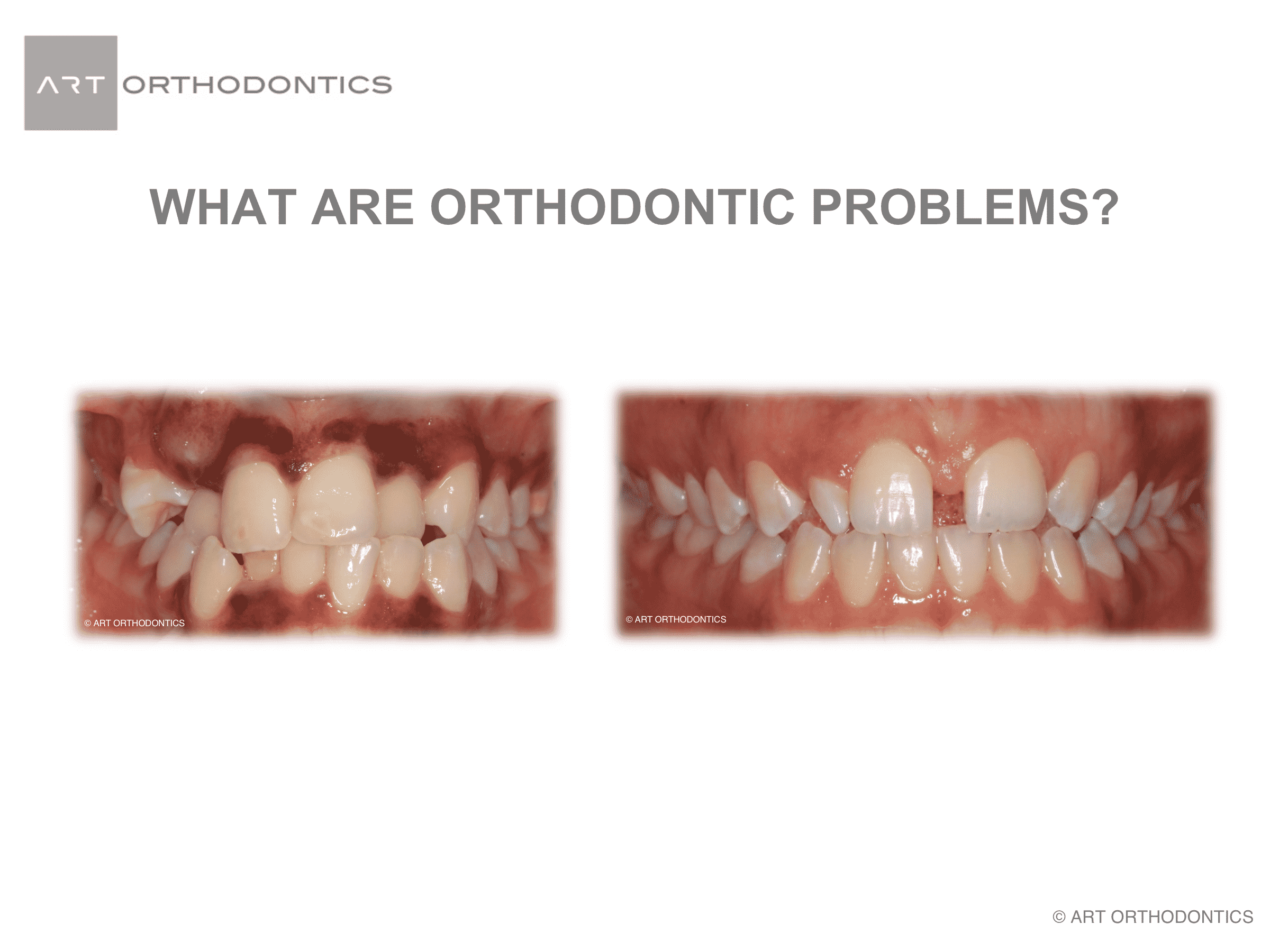 Dientes apretados y dientes con huecos como ejemplos de problemas de ortodoncia.