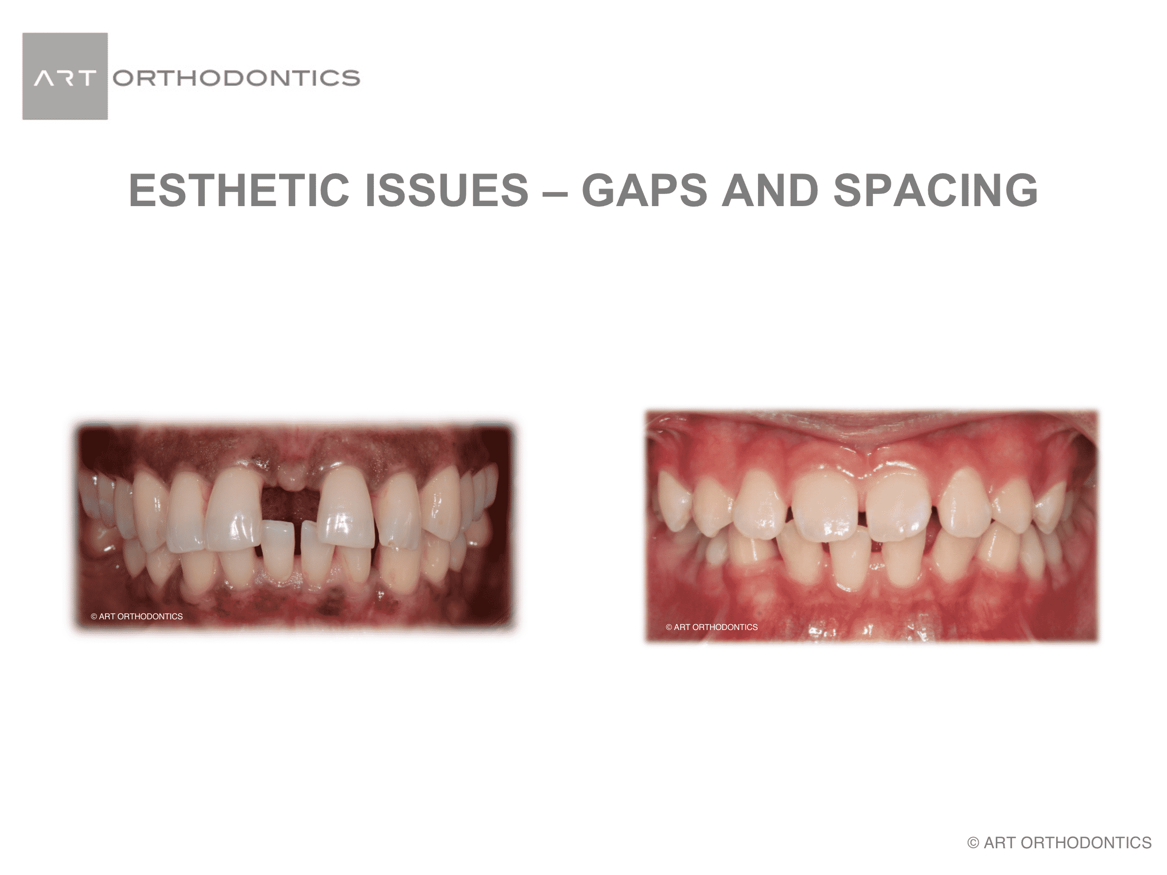 Gaps between upper and lower front teeth