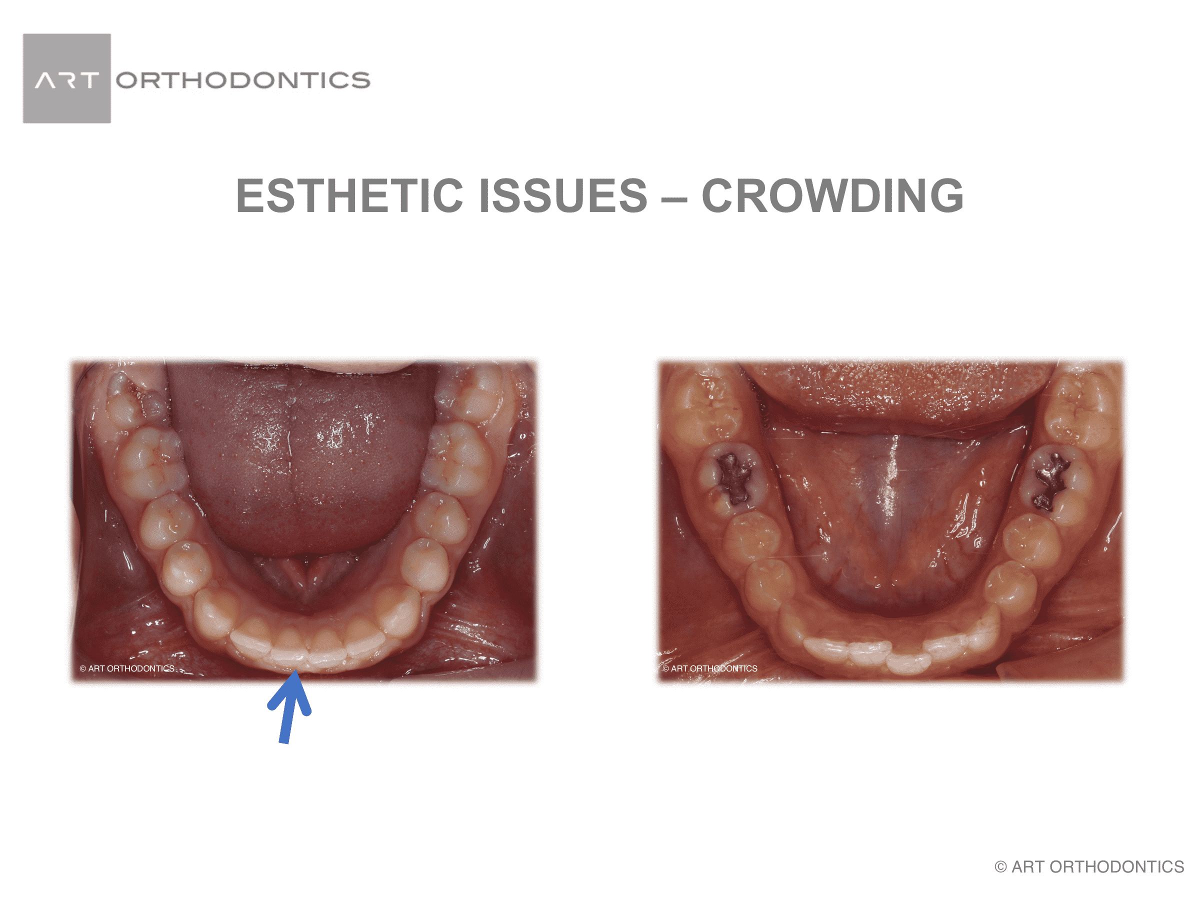 Lower anterior crowding that is mild