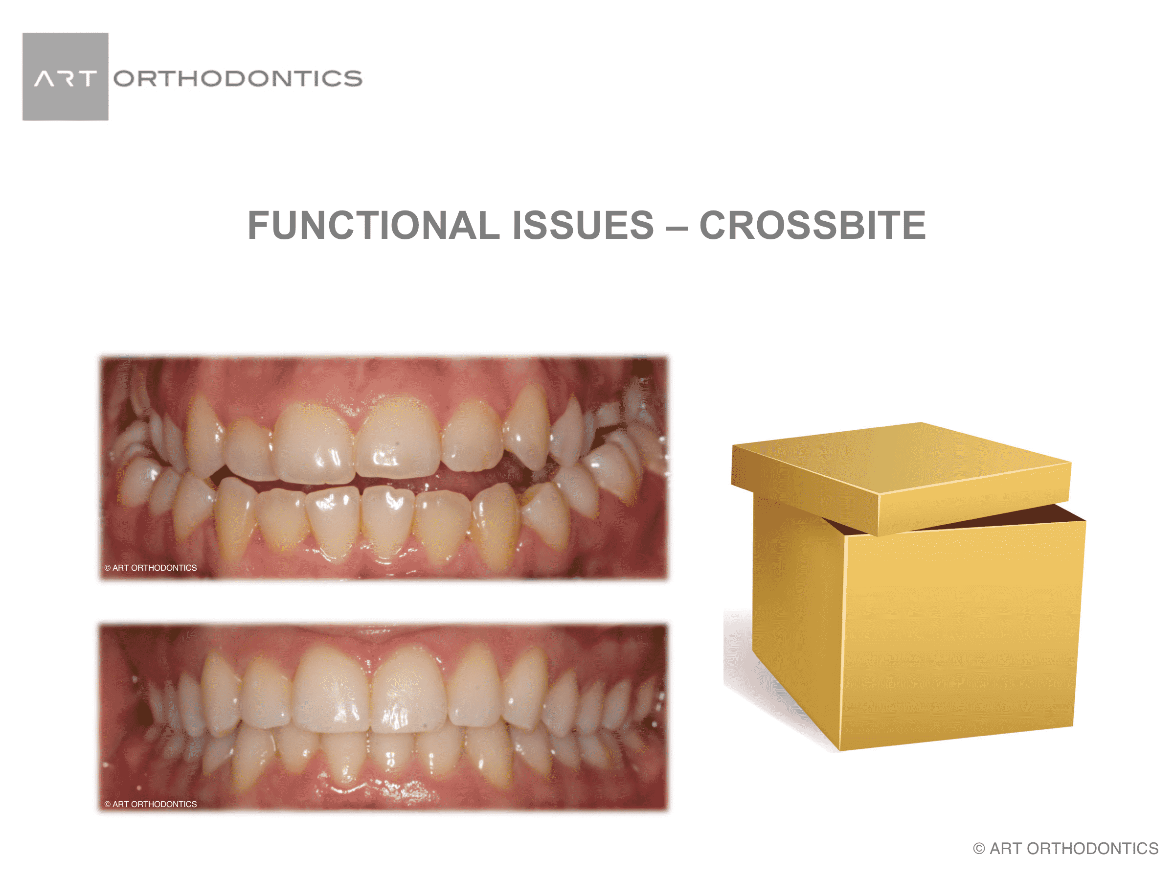 Images of a dental cross bite and a simulation with a box