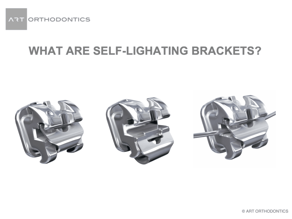 Orthodontic Brackets (Braces) How do They Work? ART Orthodontics