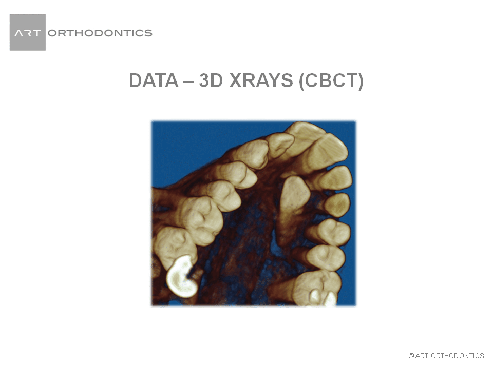 3D image of the upper jaw with an impacted canine tooth ART Orthodontics