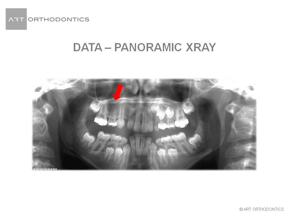 Panoramic X-ray with two missing teeth for ART Orthodontics