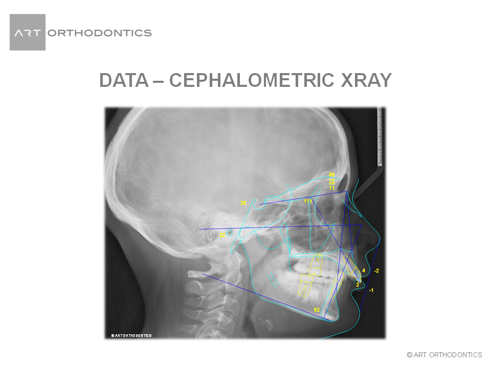 Radiografía lateral trazada (cefalométrica) para ortodoncia ART