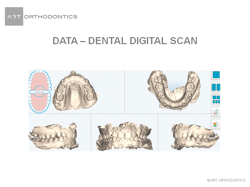 Composite images of models of teeth for ART Orthodontics