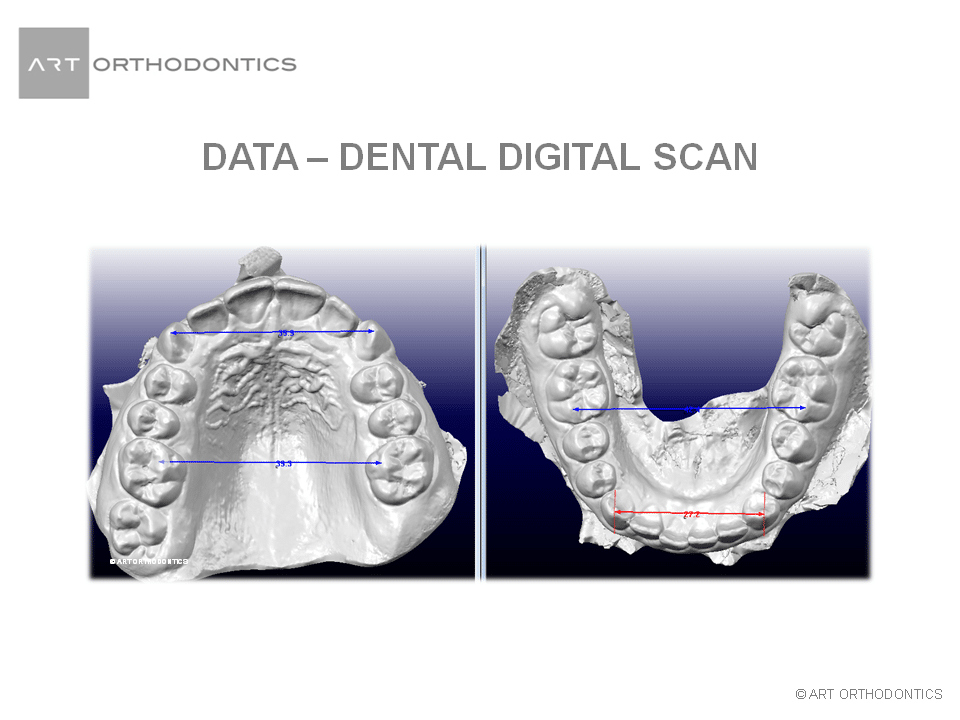 Modelos digitales de mandíbula superior e inferior ART Ortodoncia