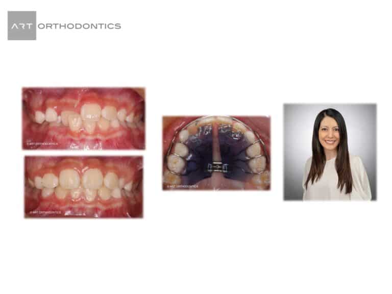 Read more about the article EARLY ORTHODONTIC TREATMENT – ANTERIOR CROSSBITE