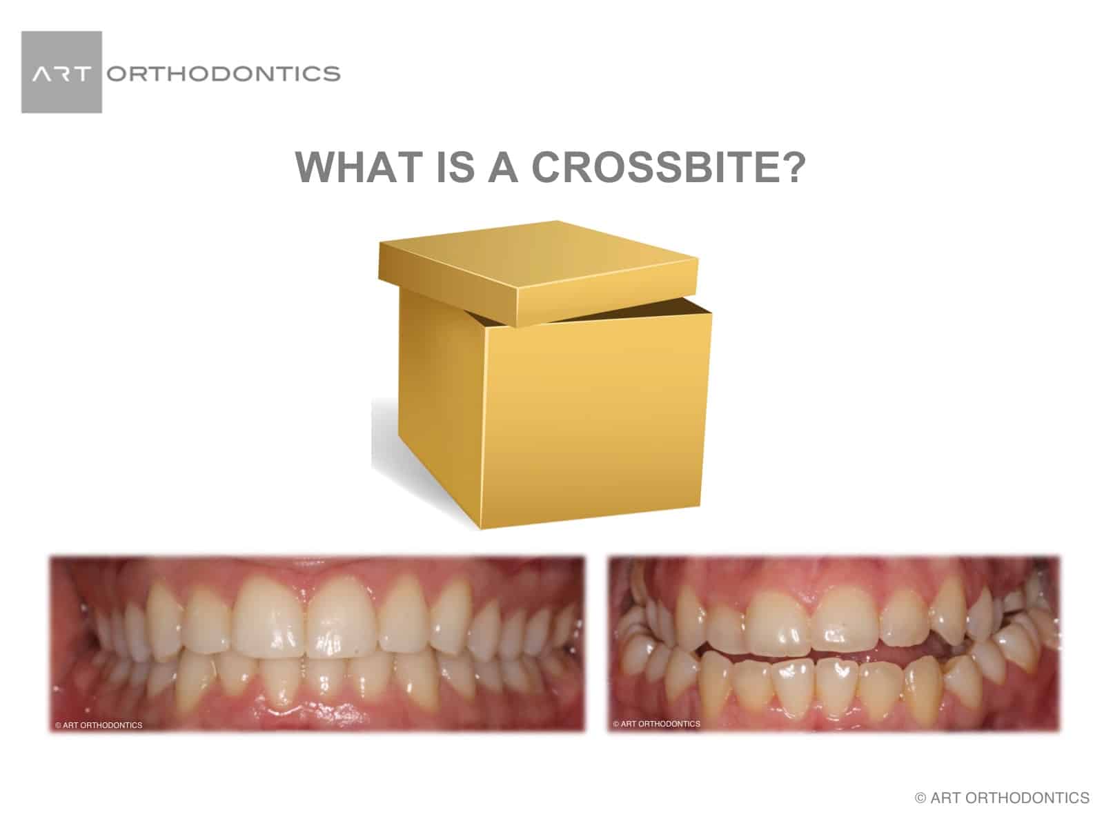 Box with lid off and dental crossbite pictures