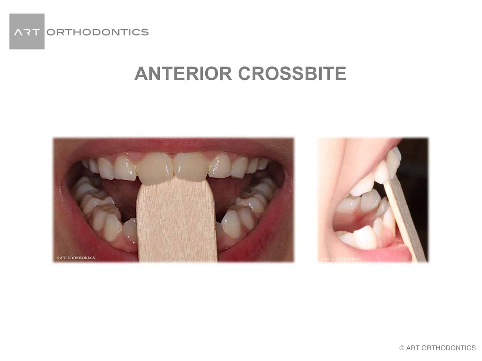 Tongue depressor correction of a crossbite