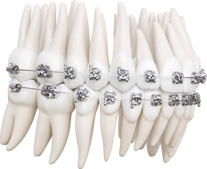 Braces and Roots of Teeth