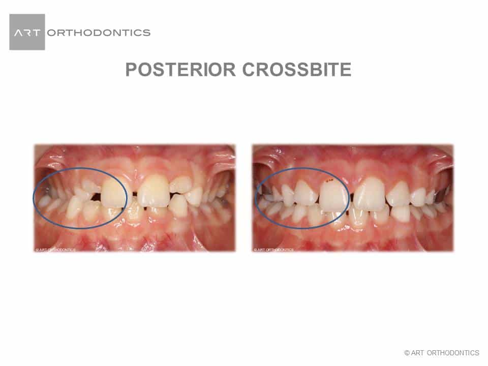 Before and After Posterior Crossbite Corrected