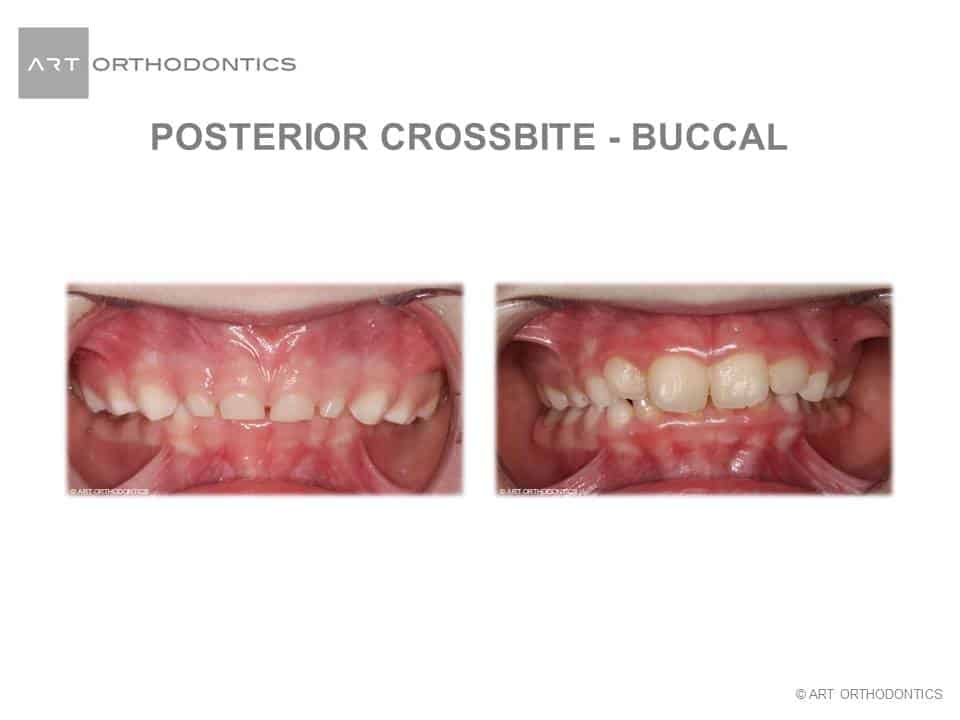 Posterior Crossbite in the Young Patient