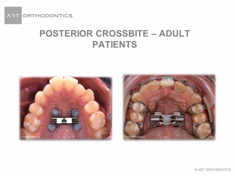 Pacientes adultos con mordida cruzada posterior con expansor