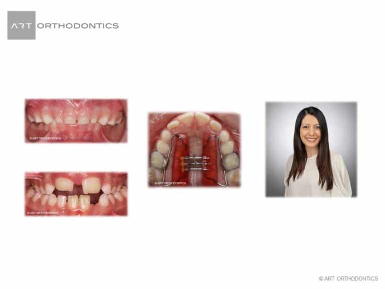 Read more about the article EARLY ORTHODONTIC TREATMENT – POSTERIOR CROSSBITE