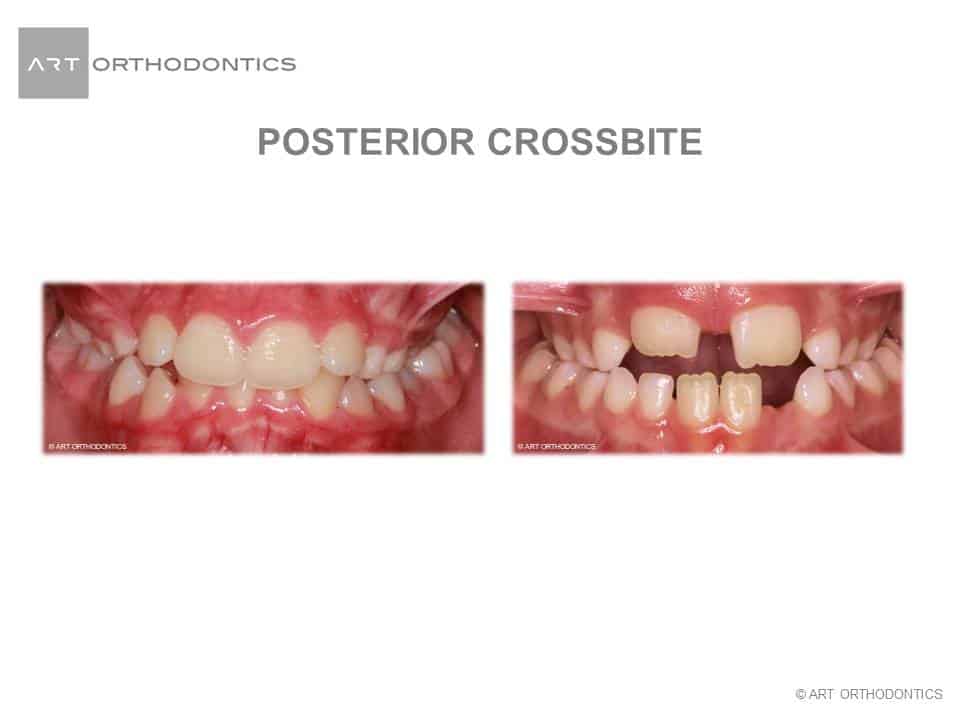 Bilateral Posterior Crossbite