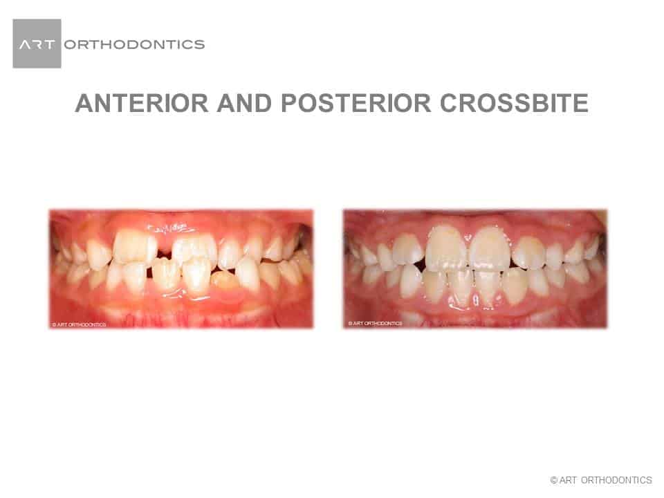 Mordidas cruzadas anterior y posterior