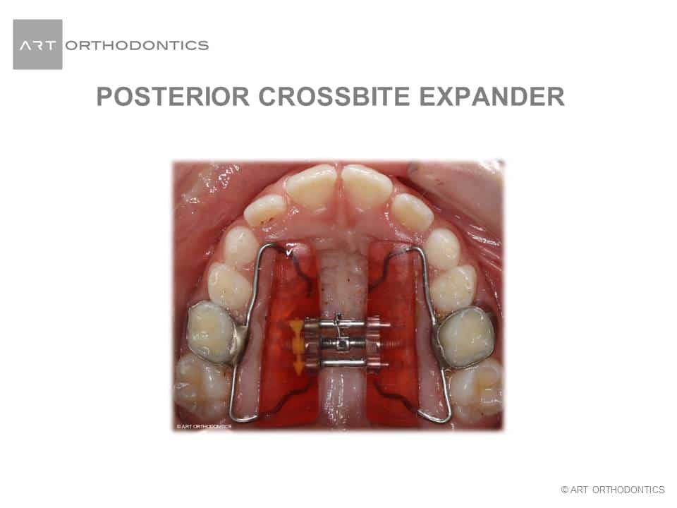 Haas expander in the upper jaw