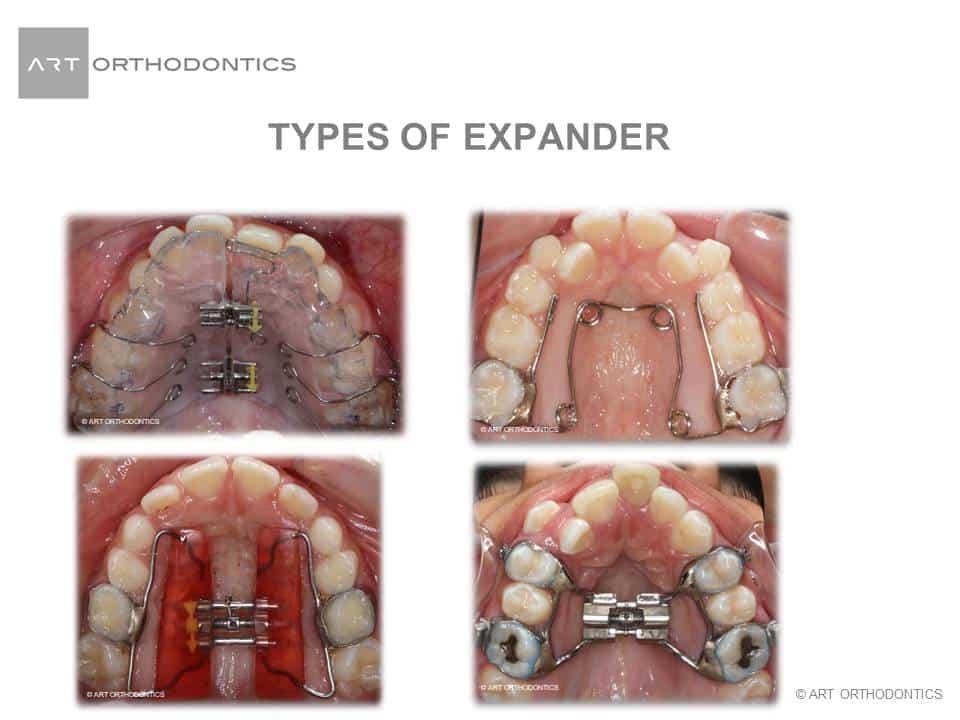 Upper Jaw Expansion Appliances