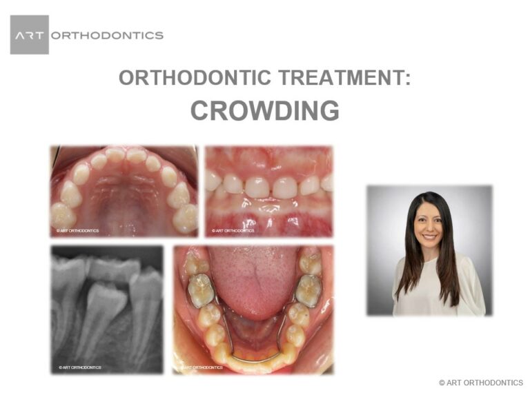 Read more about the article ORTHODONTIC TREATMENT: DENTAL CROWDING