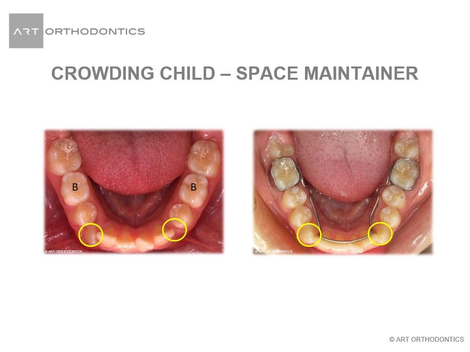 braces missing baby teeth