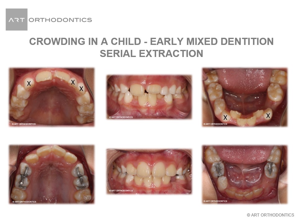 Imágenes de antes y después de los dientes