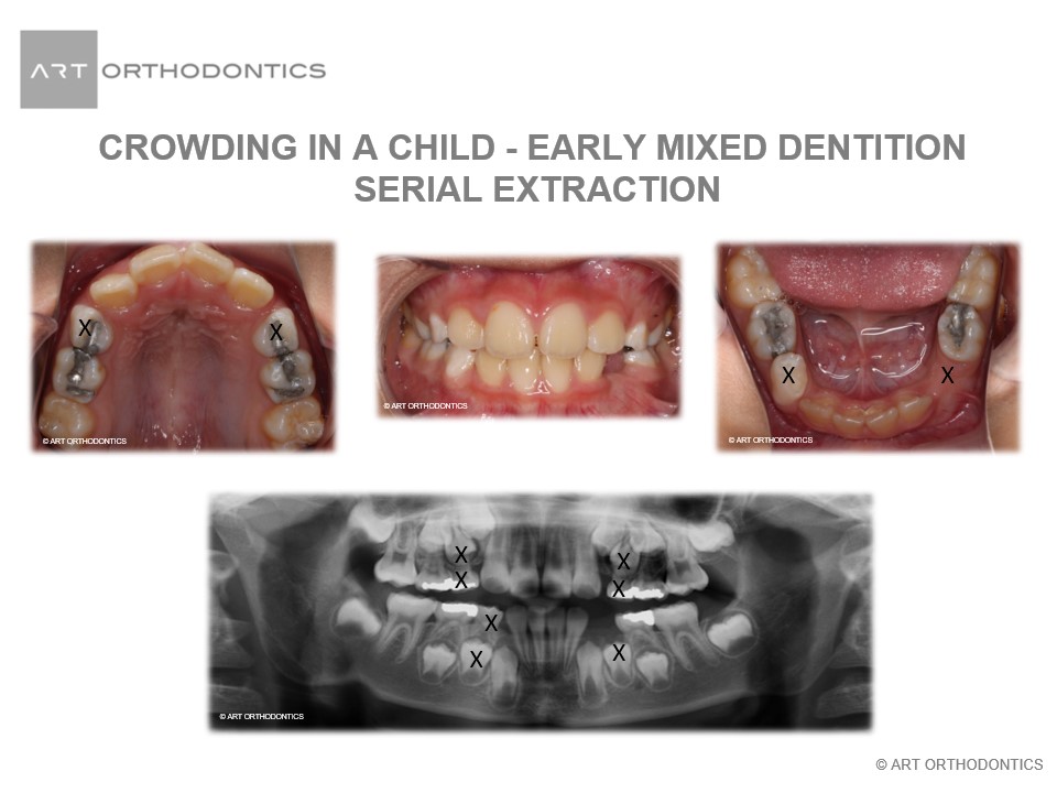 Radiografía de dientes para extracciones seriadas