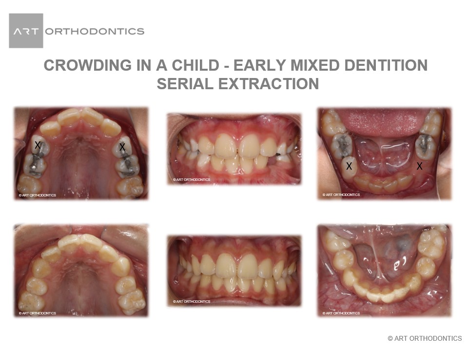 Serial Extraction Finished Smile