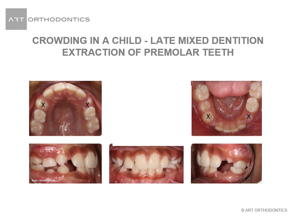 Serial Extraction of Teeth